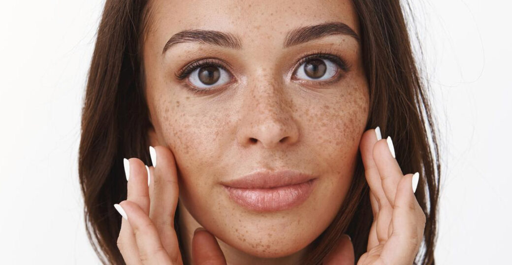 hyperpigmentation
