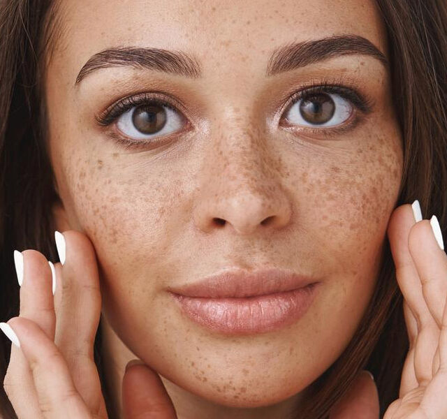 hyperpigmentation