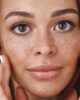 hyperpigmentation
