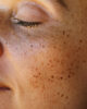 Hyperpigmentation dark skin